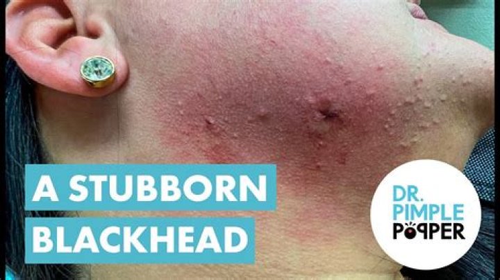 Dr. Pimple Popper just gifted the internet with two videos that show the effect of blackhead tweezer
