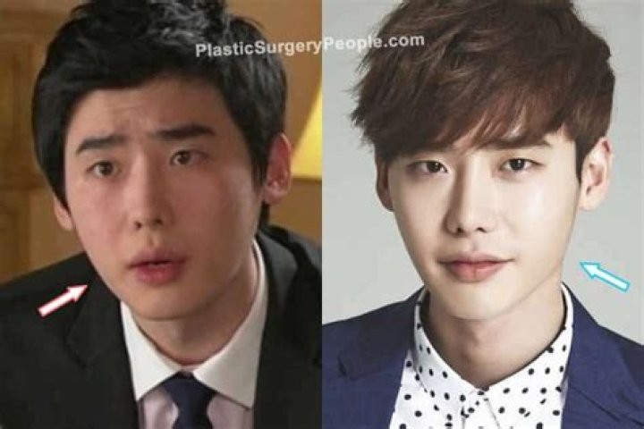 Lee Jong Suk | Before Plastic Surgery? Wrong With His Face? ·