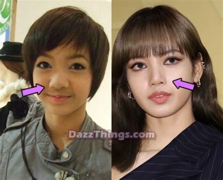 Lisa Before Plastic Surgery Unveiled